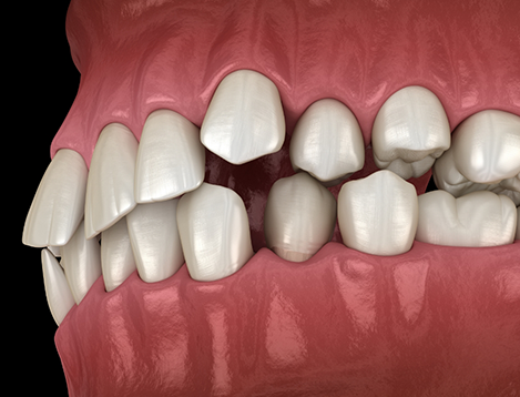 Illustration of crooked teeth