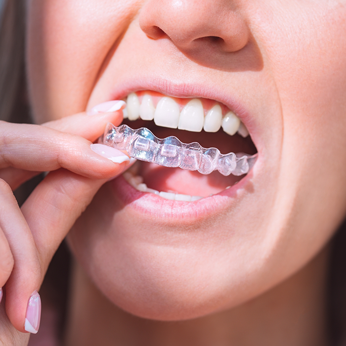 Close-up of woman placing Invisalign over her teeth