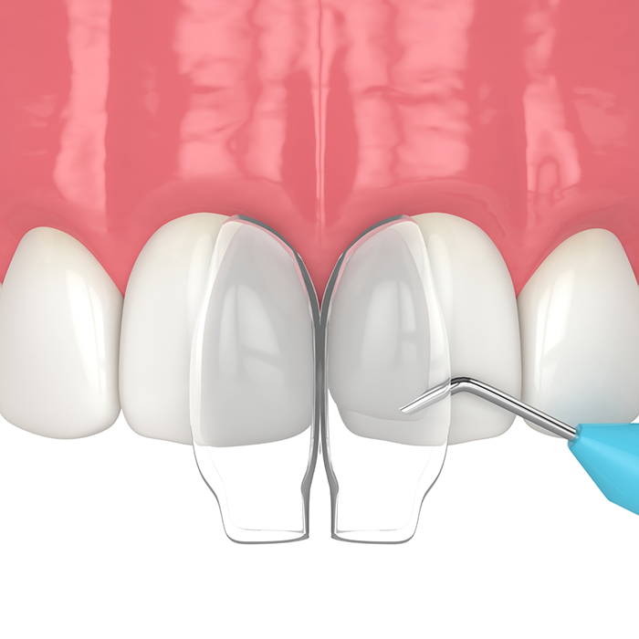 Illustration of dental bonding being performed on upper teeth