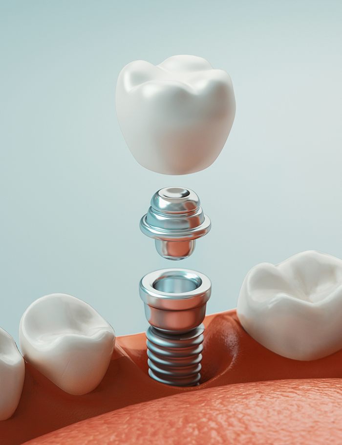 Illustration of abutment and crown being attached to dental implants