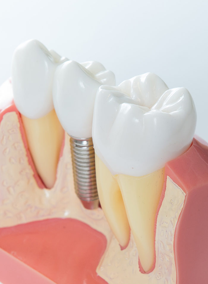 Close-up of model of dental implant