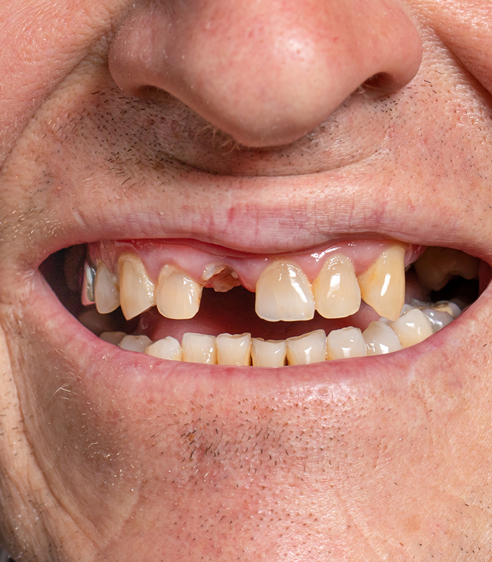 Close-up of smile with multiple missing teeth