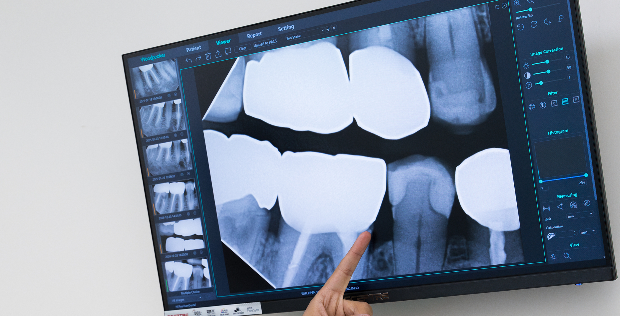 Close-up of dental X-rays on monitor