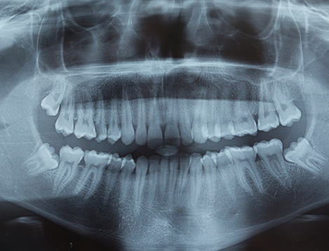 Extraoral X-ray showing teeth