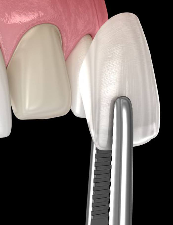 Illustration of dental veneer being placed on prepared tooth