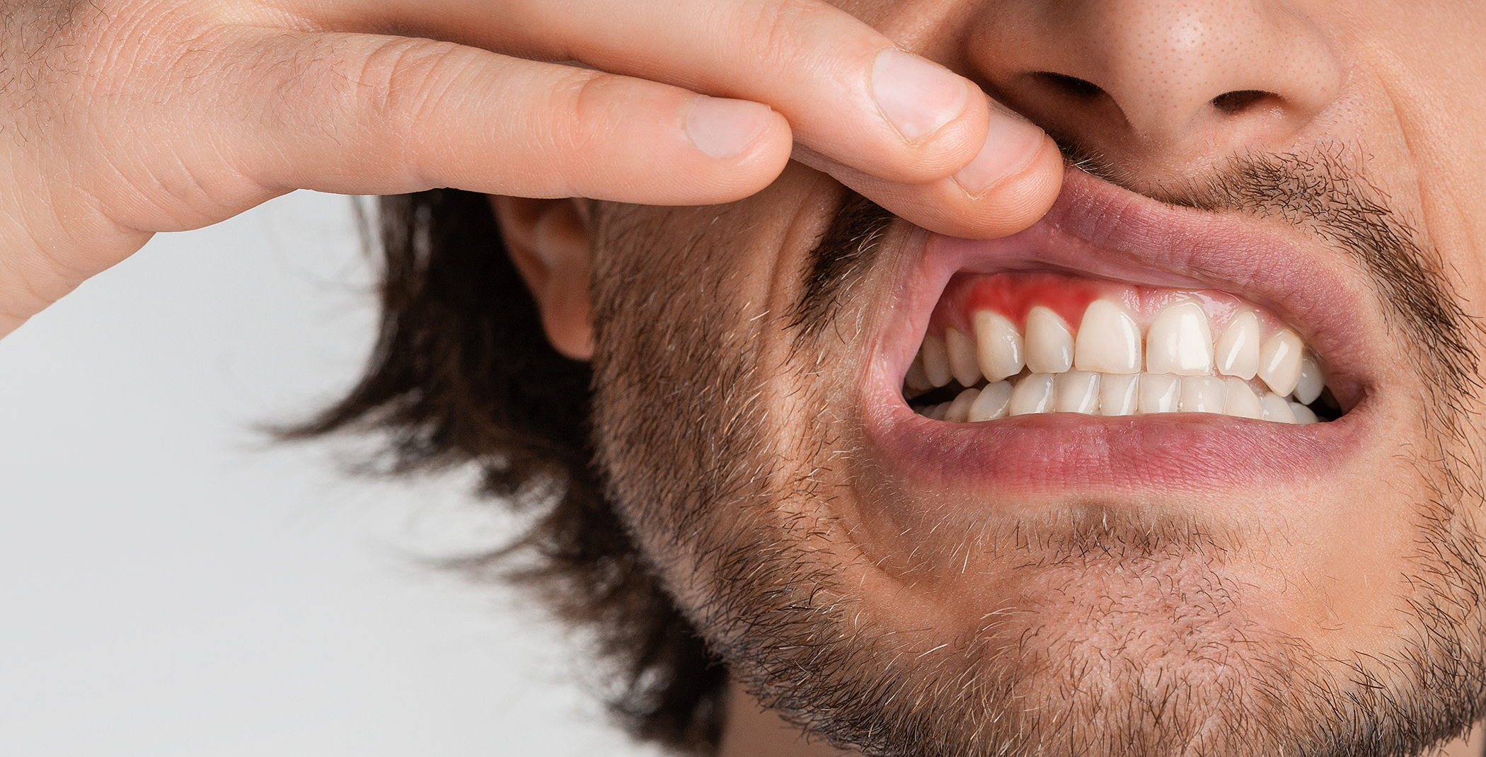 Man pulling up lip to show signs of gum disease in Raynham