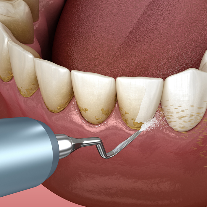 Illustration of scaling and root planing performed for lower teeth