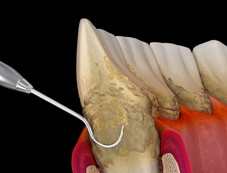 Illustration of side view of scaling and root planing