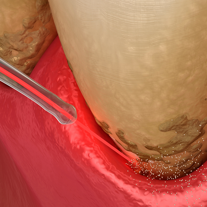 Illustration of laser being used to treat gum disease