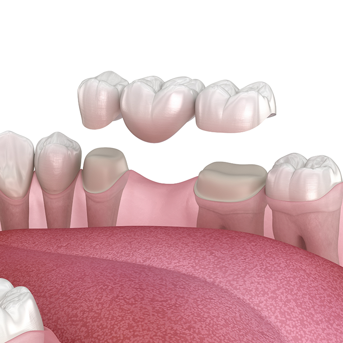 Illustration of dental bridge being attached to teeth