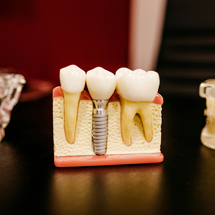 Model of dental implant sitting on desk