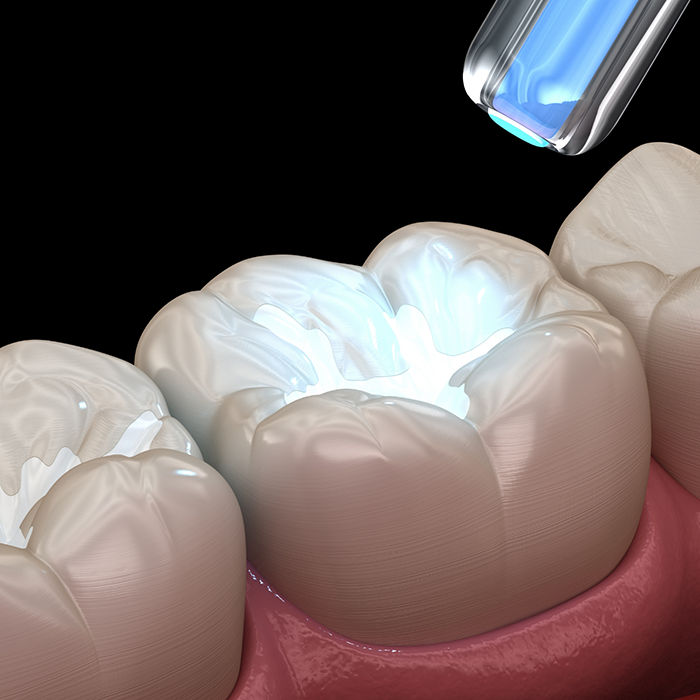Illustration of a tooth-colored filling being applied