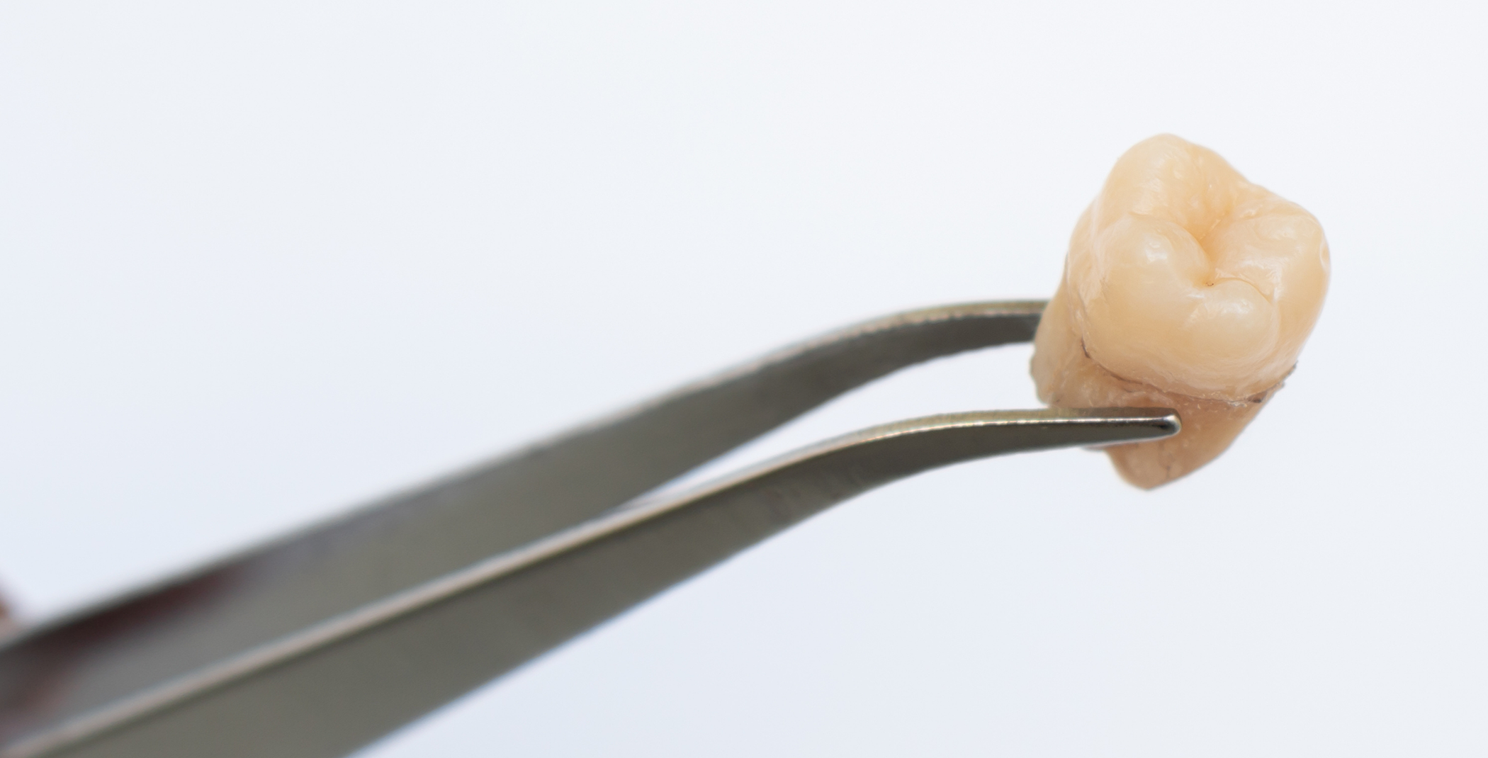 Close-up of tooth held in forceps after tooth extraction in Raynham