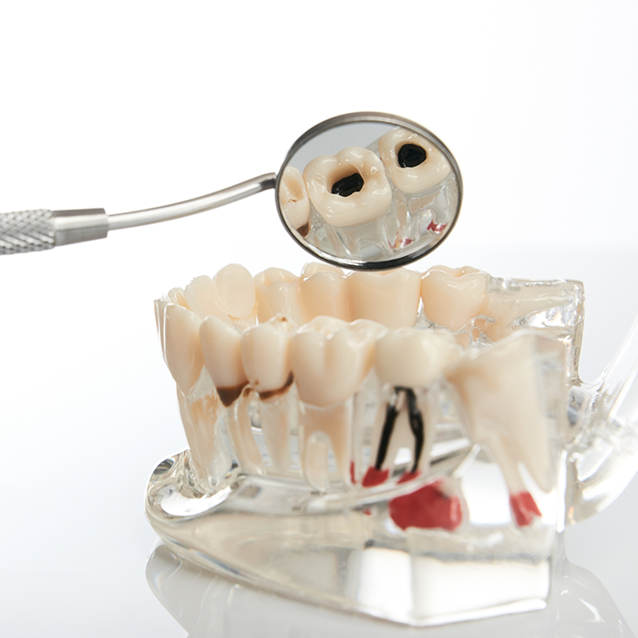 Dental mirror examining model of mouth with decayed teeth