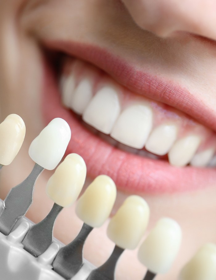 A close-up of a patient's smile showing teeth whitening results
