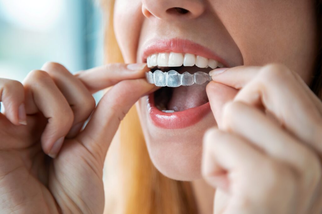Nose-to-neck closeup of woman putting Invisalign over upper arch